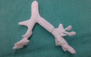 3D Printing Saves a Child's Life